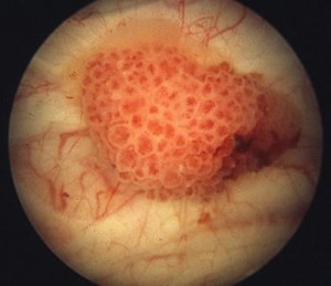 Cistectomia no câncer de bexiga